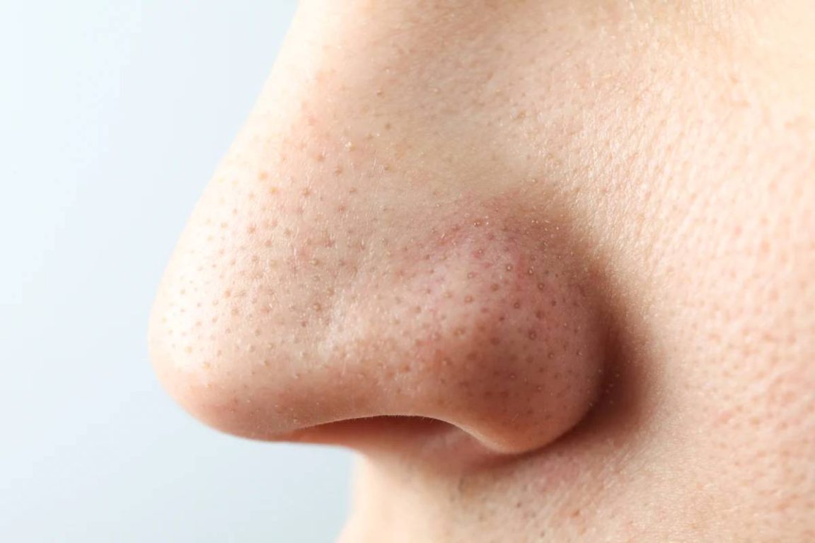 Blackheads on nose