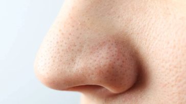 Blackheads on nose