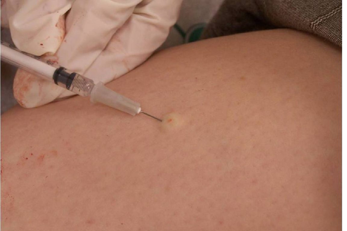 Skin biopsy