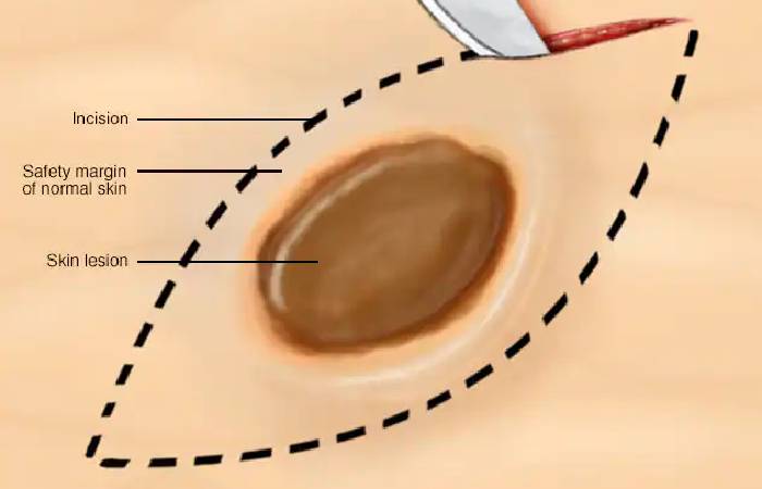 incision biopsy