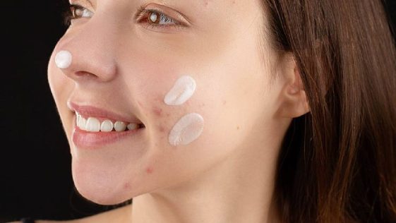 Moisturizer for Acne prone skin