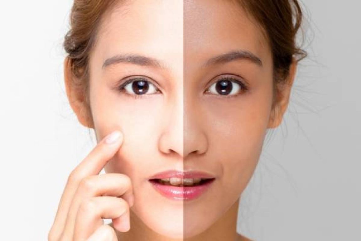 Skin Whitening Treatment (1)