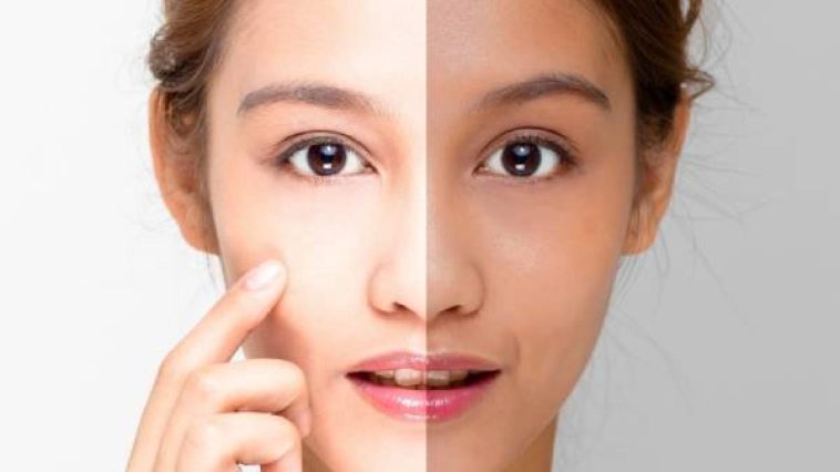 Skin Whitening Treatment (1)