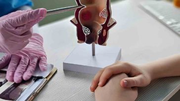 Best Ointment for Anal Fissure